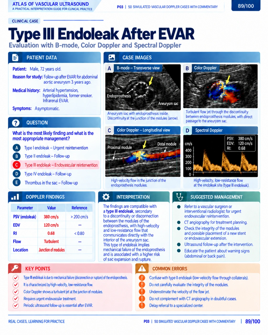 Page 89: Case: type III endoleak after EVAR. English preview of the digital vascular Doppler material.